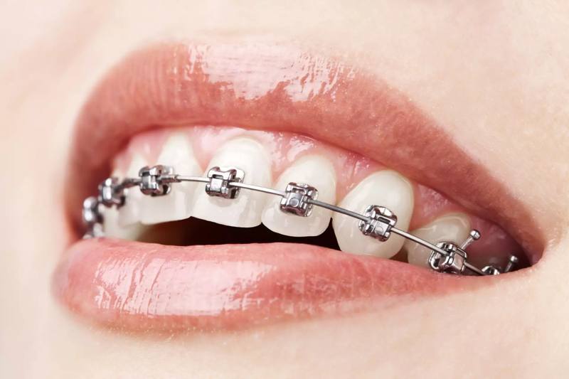 Aparelho ortodôntico fixo com braquetes metálicos