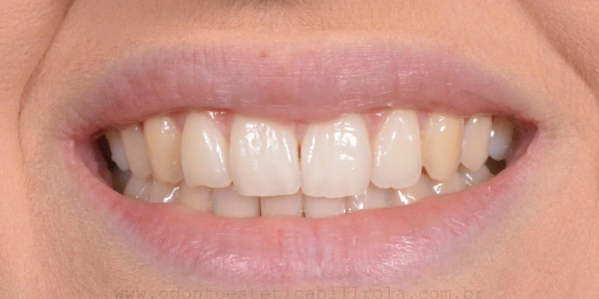 Dentes antes do clareamento dental
