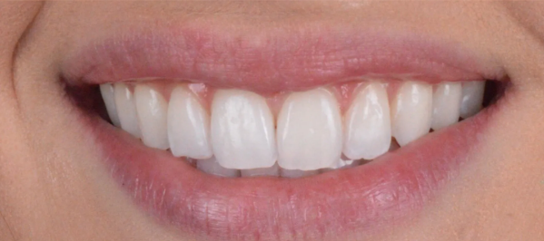 Dentes depois do clareamento dental
