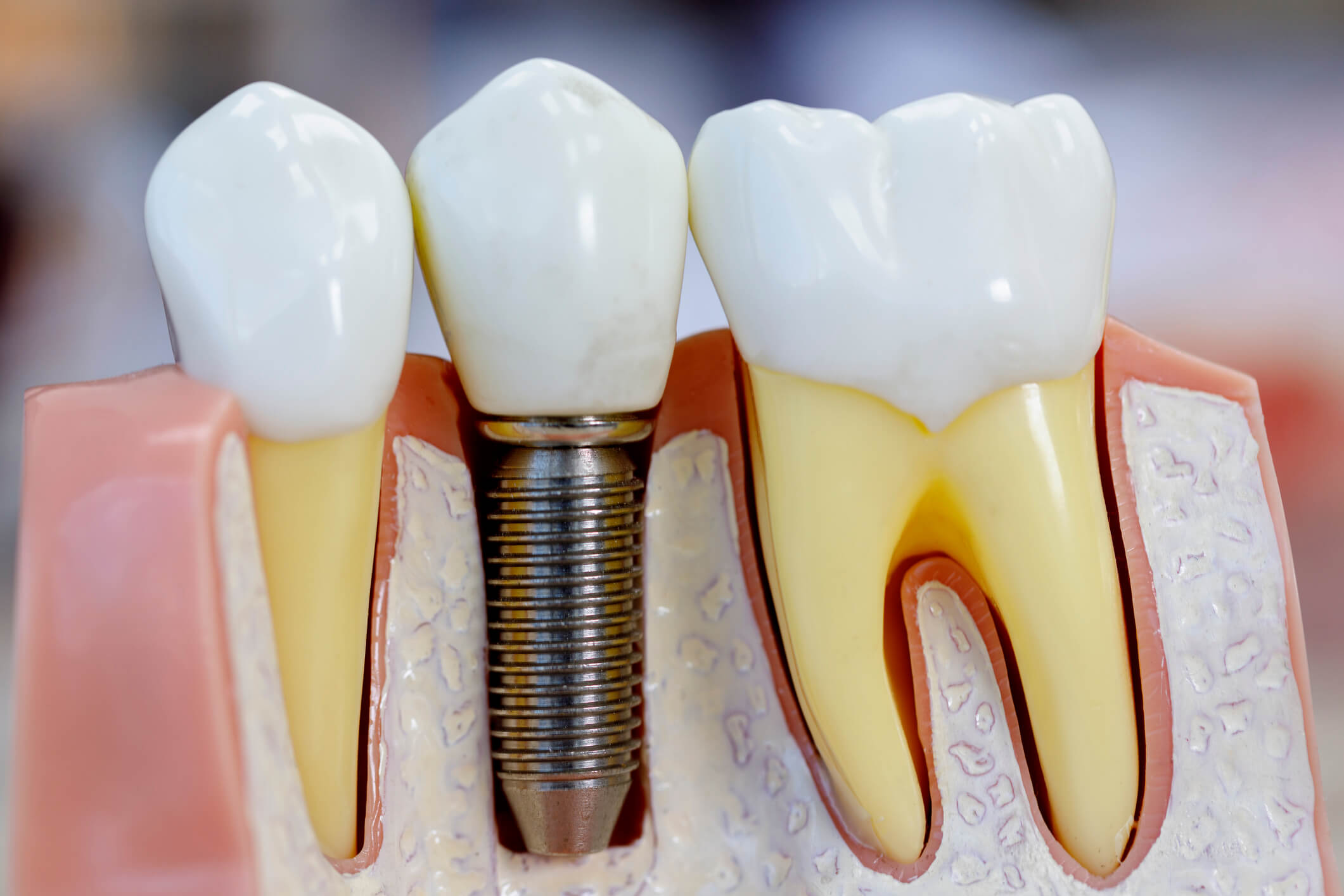Implante dentário