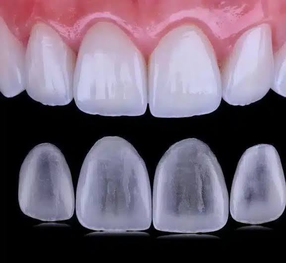 Lentes de contato dental