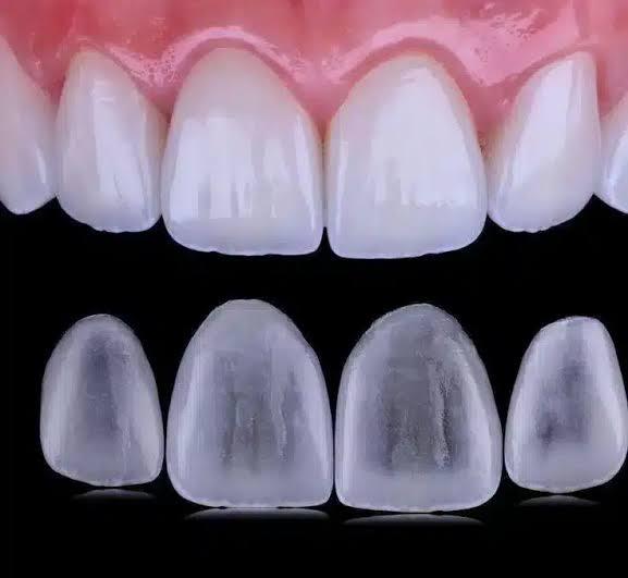 Lentes de contato dental em São José/SC