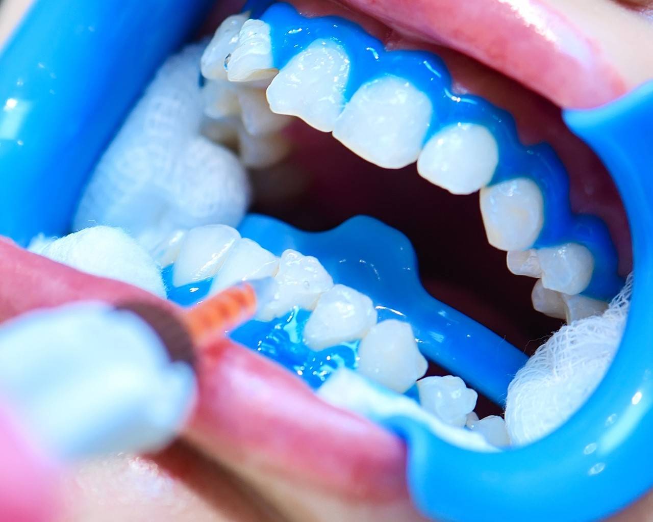 Clareamento Dental Caseiro Funciona? O Que Saber Antes de Começar