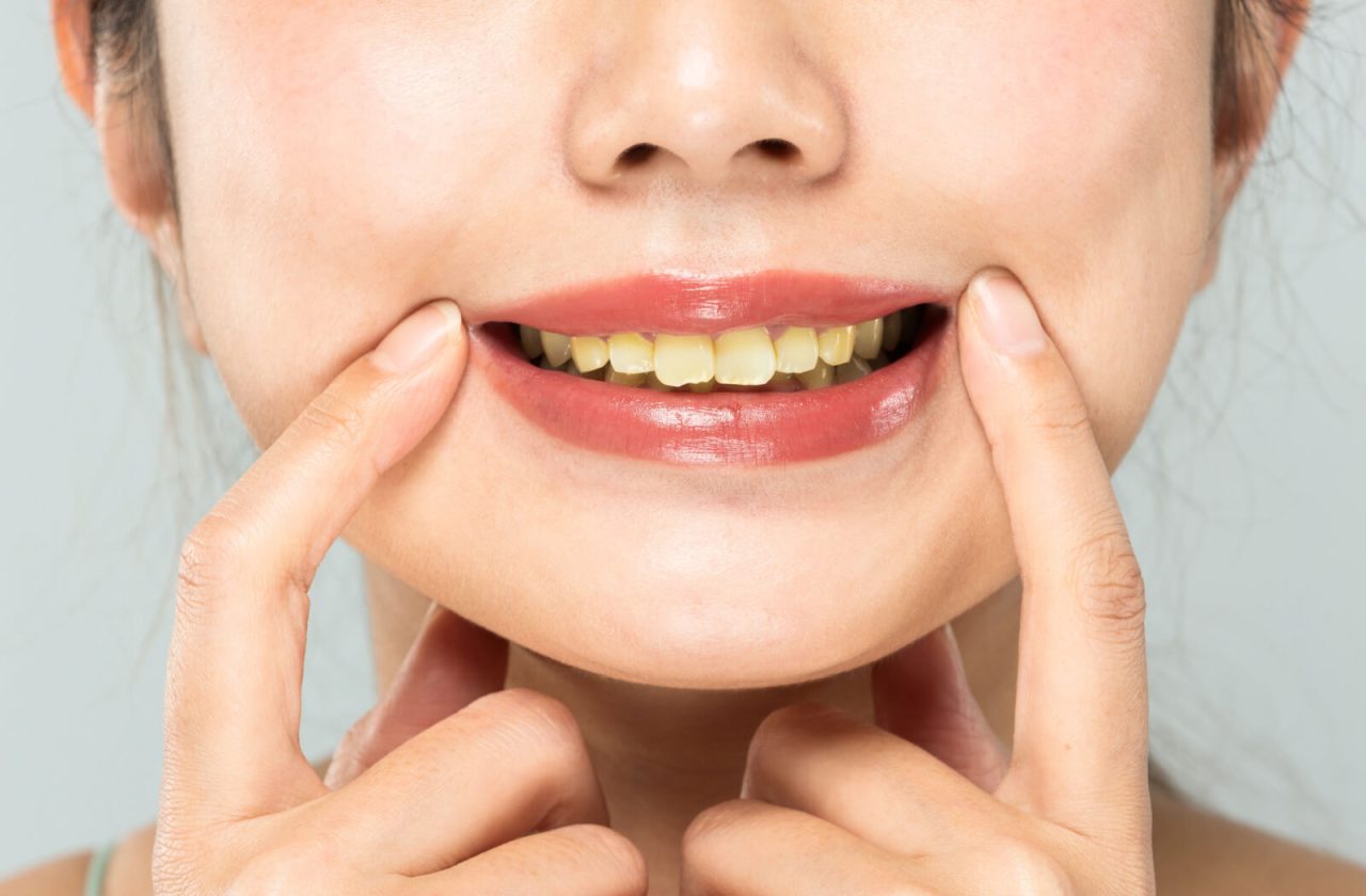 Dentes Amarelos: Por Que Acontece e o Que Fazer
